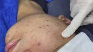 053 • Acne collection • АСМР • Relax Spa