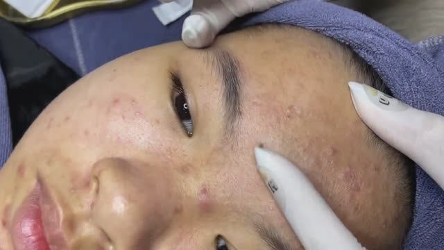 Глубокая механическая чистка лица