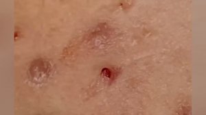 Выдавливание прыщей, угрей, черных точек и камедонов #332