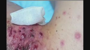 Профессиональное удаление черных точек