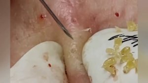 Выдавливание прыщей, угрей, черных точек и камедонов #331