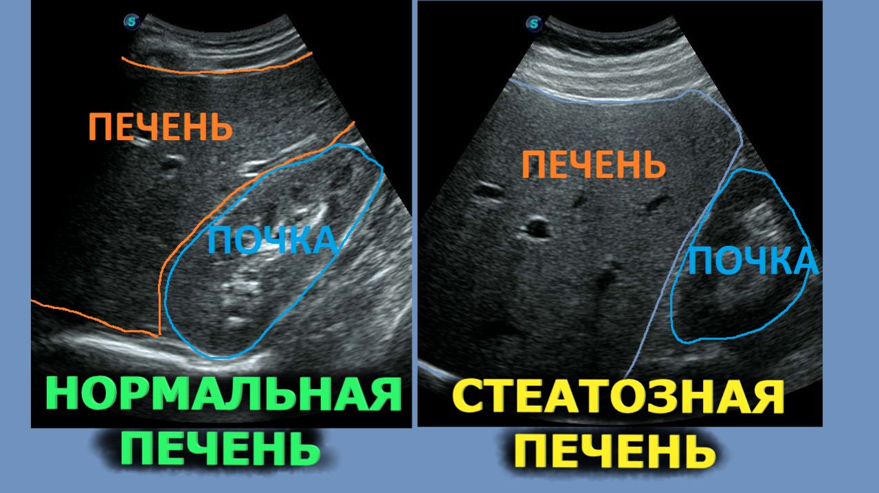 Степени жирового гепатоза печени на УЗИ
