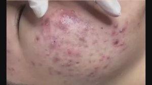 Механическая чистка лица: удаление акне