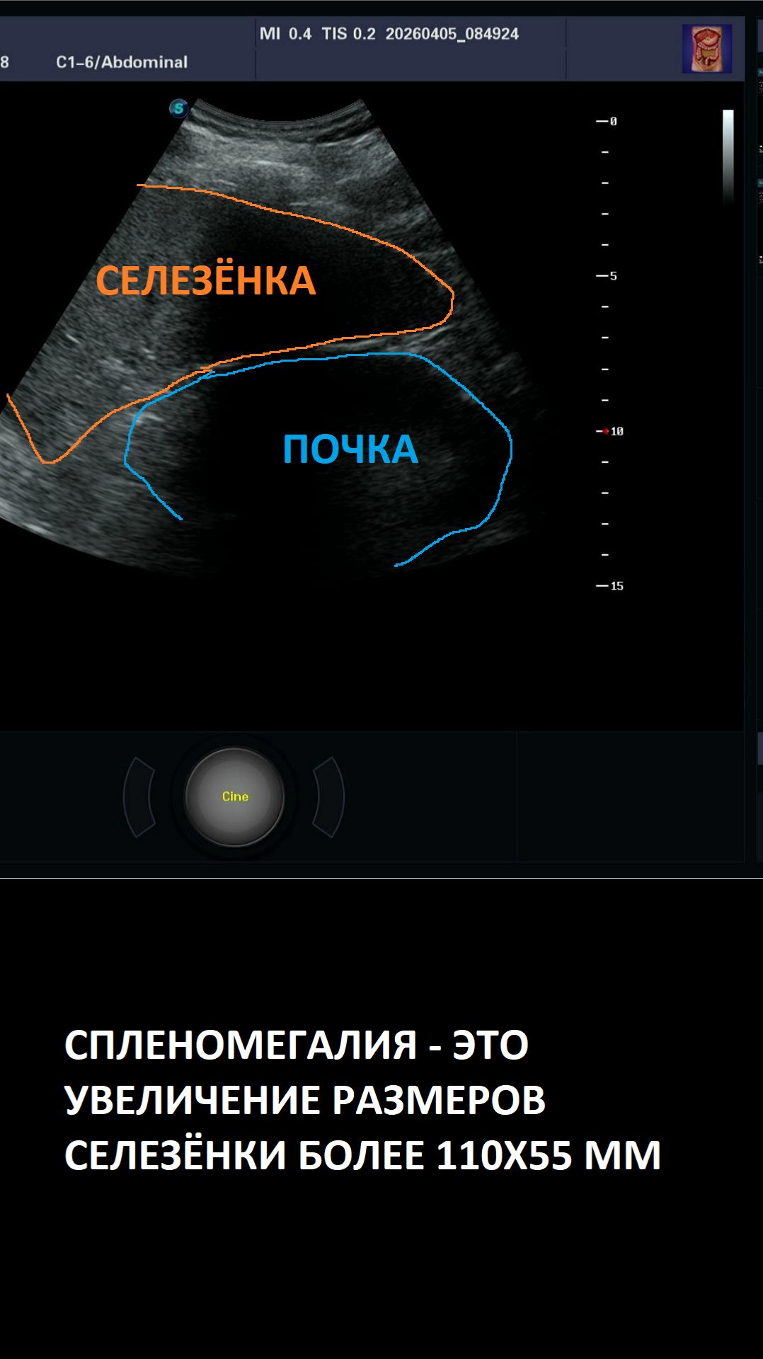 Спленомегалия на УЗИ