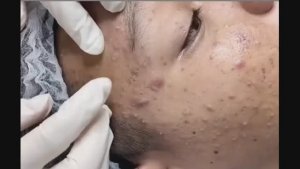 Удаление милиумов и закрытых комедонов