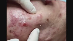 Глубокая механическая чистка лица