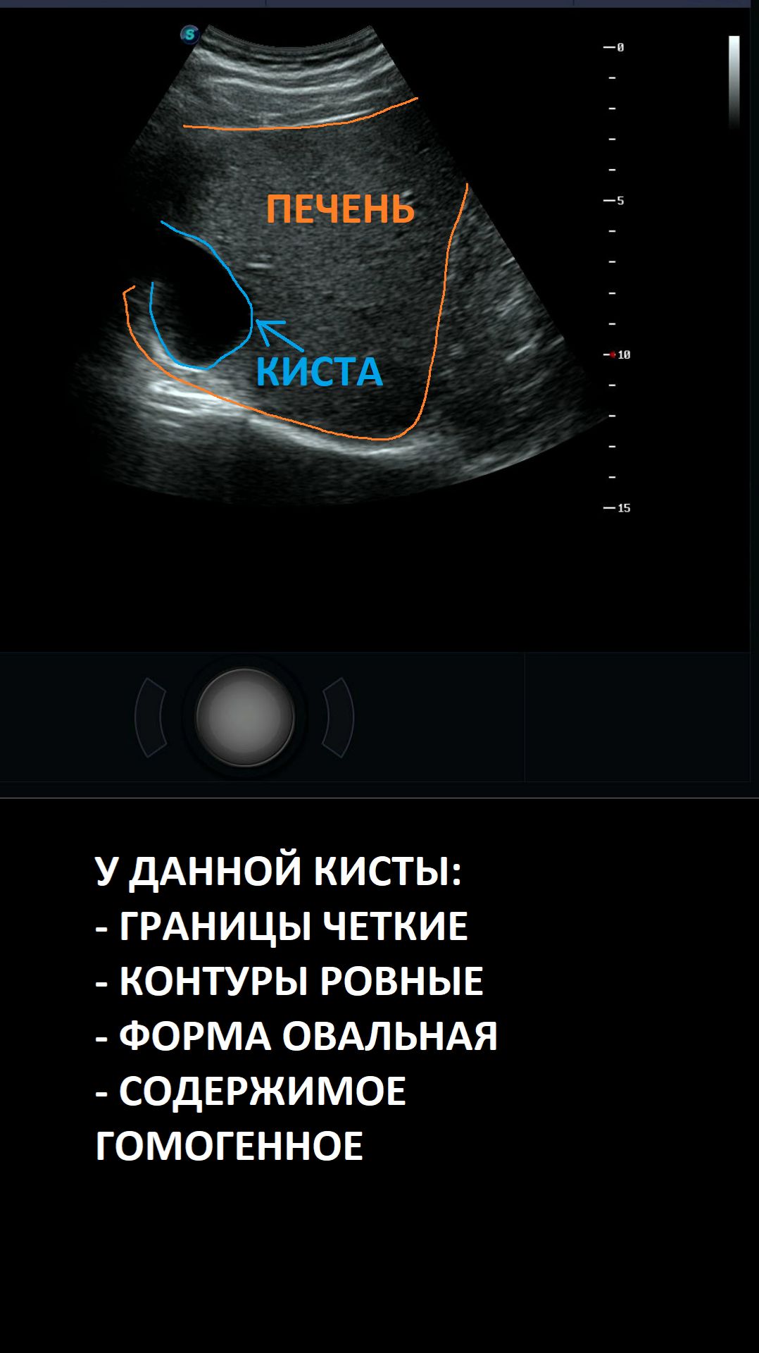 Простая киста печени на УЗИ