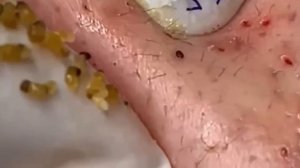 #232 Чистка лица от угрей и акне. Выдавливание прыщей. Удаление черных точек и комедонов