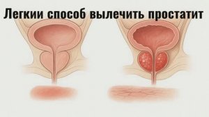 Легкий способ вылечить простатит