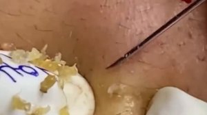 #233 Чистка лица от угрей и акне. Выдавливание прыщей. Удаление черных точек и комедонов