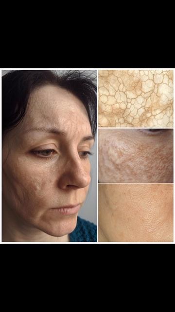 Склеродермия - это не болезнь кожи!