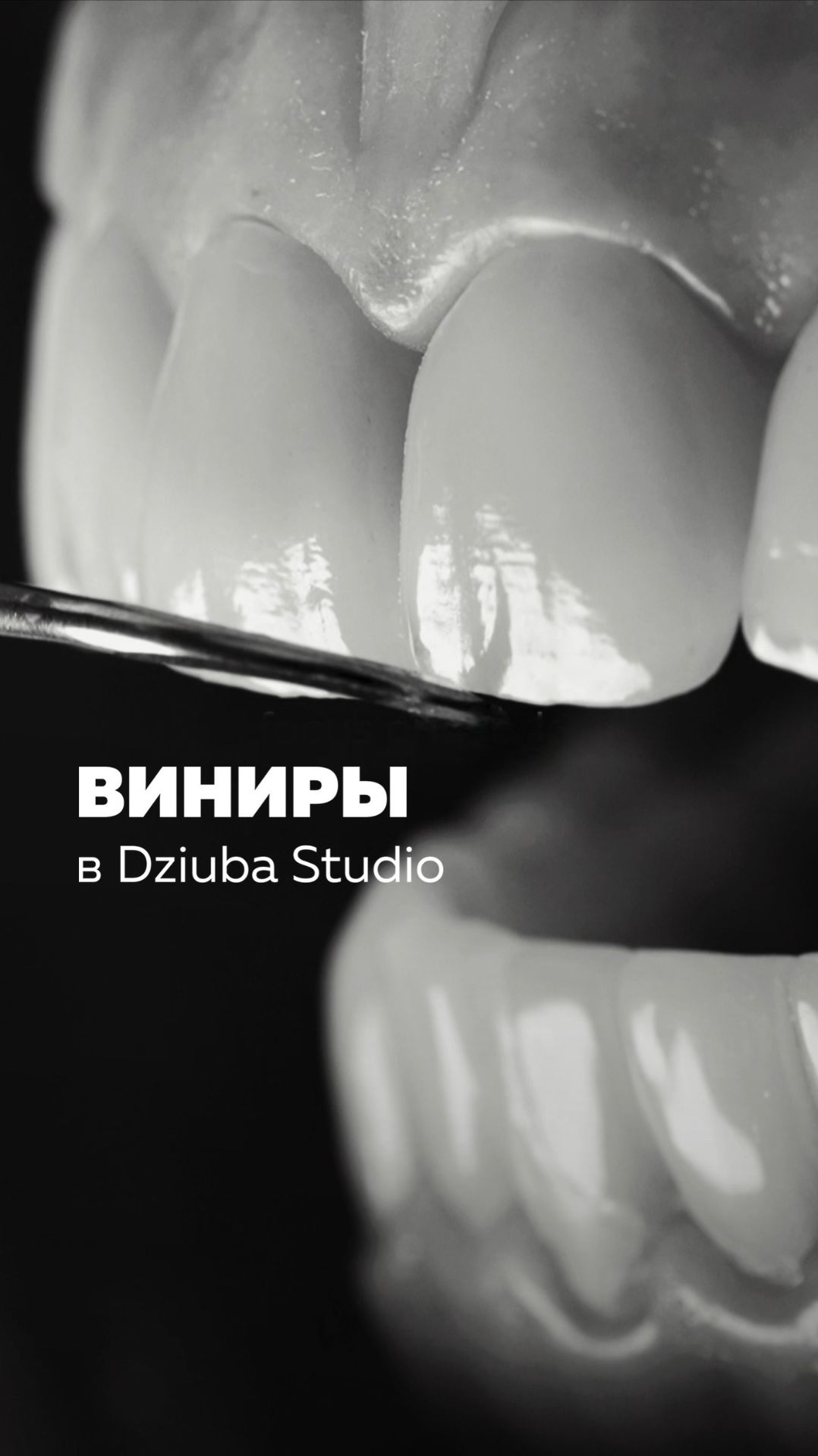 Виниры в Dziuba Studio