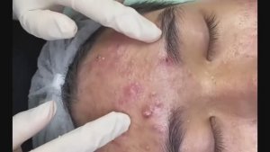 Чистка лица: убираем всё, что его портит