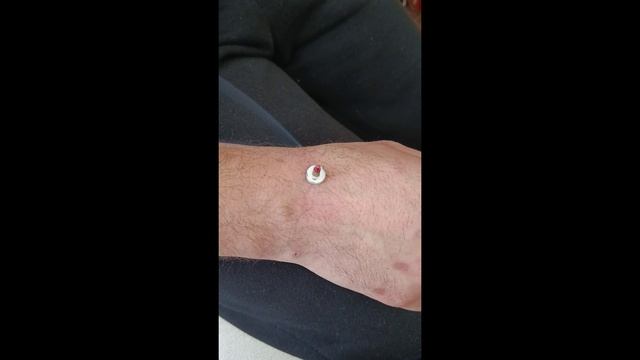 Прогревание болевой точки моксой