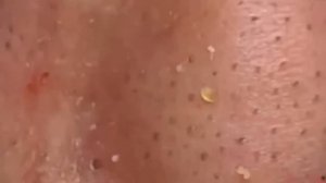 #234 Чистка лица от угрей и акне. Выдавливание прыщей. Удаление черных точек и комедонов