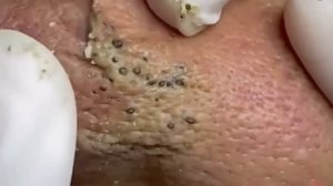 #237 Чистка лица от угрей и акне. Выдавливание прыщей. Удаление черных точек и комедонов