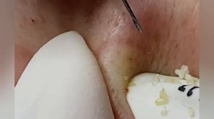 Выдавливание прыщей, угрей, черных точек и камедонов #335