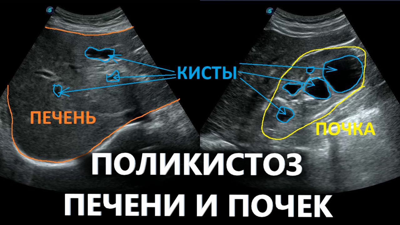 Поликистоз печени и почек на УЗИ
