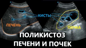 Поликистоз печени и почек на УЗИ