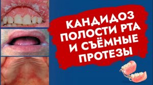 Как предупредить кандидоз при использовании съемных протезов?