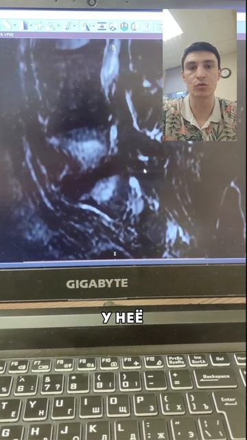 Растяжка разрушает поясницу. #здоровье #спина #реабилитация #упражнения