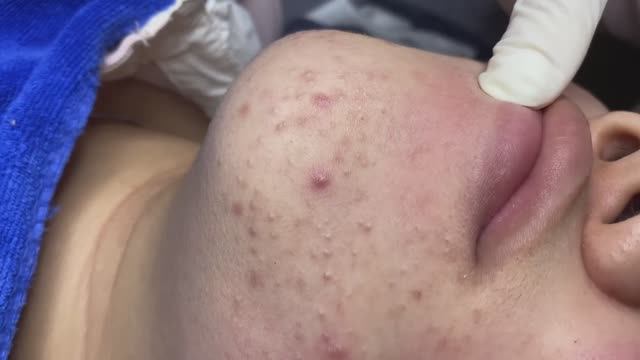 Очищение кожи от комедонов.