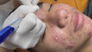 Уничтожение черных точек и прыщей