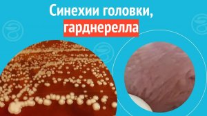 😮 Синехии головки, гарднерелла, уреаплазма и кандида. Клинический случай №1312