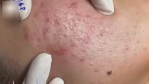 Удаление черных точек и акне: эстетический оргазм