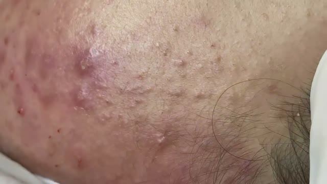 057 • Acne collection • АСМР • Relax Spa