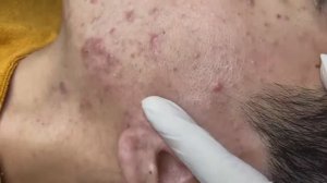 059 • Acne collection • АСМР • Relax Spa