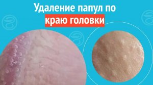 ✅ Удаление папул по краю головки. Клинический случай №1322