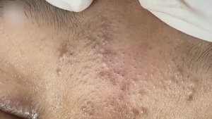 Удаление черных точек и акне — чистая эстетика