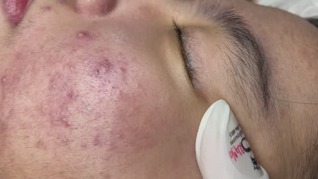 ЛЕЧЕНИЕ АКНЕ удовлетворение и релакс