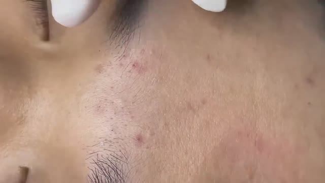 060 • Acne Collection • АСМР • Relax Spa