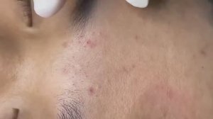 060 • Acne collection • АСМР • Relax Spa