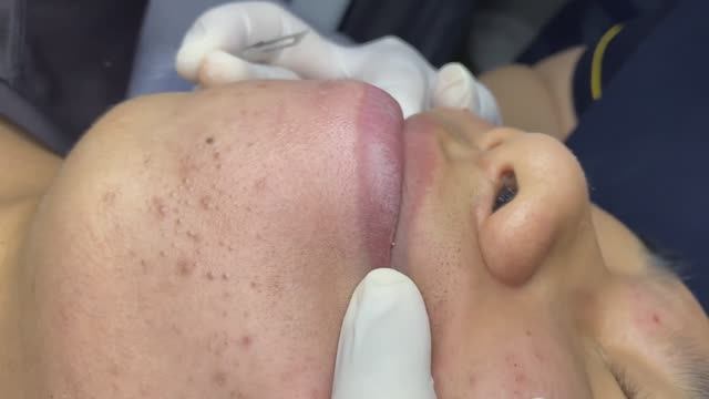 ЛЕЧЕНИЕ АКНЕ удовлетворение и релакс