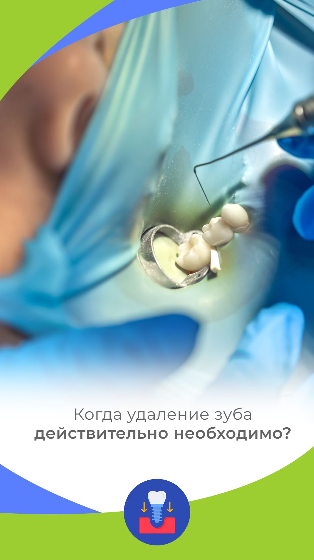 Когда удаление зуба действительно необходимо?