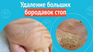 🦶 Удаление больших бородавок стоп. Клинический случай №1314