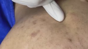 058 • Acne collection • АСМР • Relax Spa