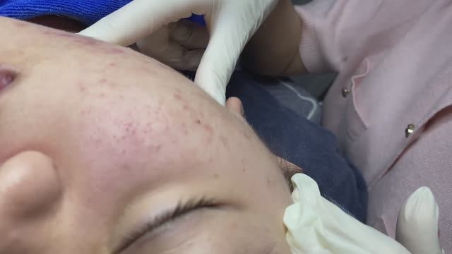 ЛЕЧЕНИЕ АКНЕ удовлетворение и релакс