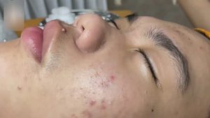 Экстракция комедонов и воспаленных элементов