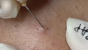 Жесткая экстракция черных точек и угрей