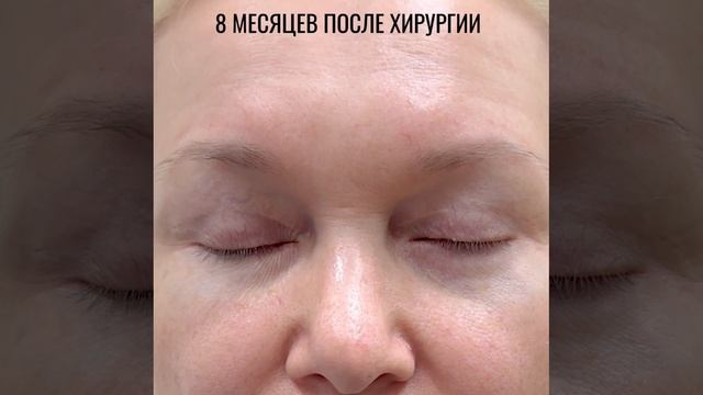 8 месяцев после операции верхняя-нижняя блефаропластика