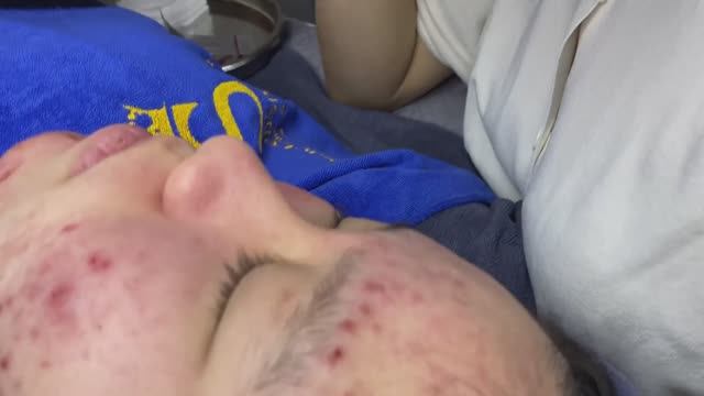 Очищение кожи от комедонов.