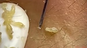 #235 Чистка лица от угрей и акне. Выдавливание прыщей. Удаление черных точек и комедонов