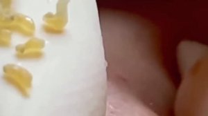 #236 Чистка лица от угрей и акне. Выдавливание прыщей. Удаление черных точек и комедонов