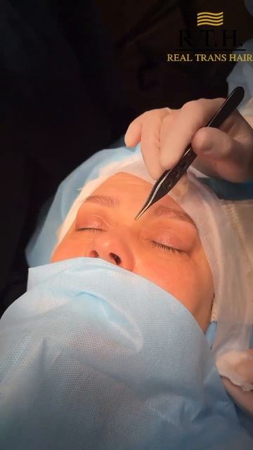 Блефаропластика