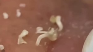 #238 Чистка лица от угрей и акне. Выдавливание прыщей. Удаление черных точек и комедонов