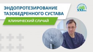 Асептический некроз головки бедренной кости — эндопротезирование тазобедренного сустава